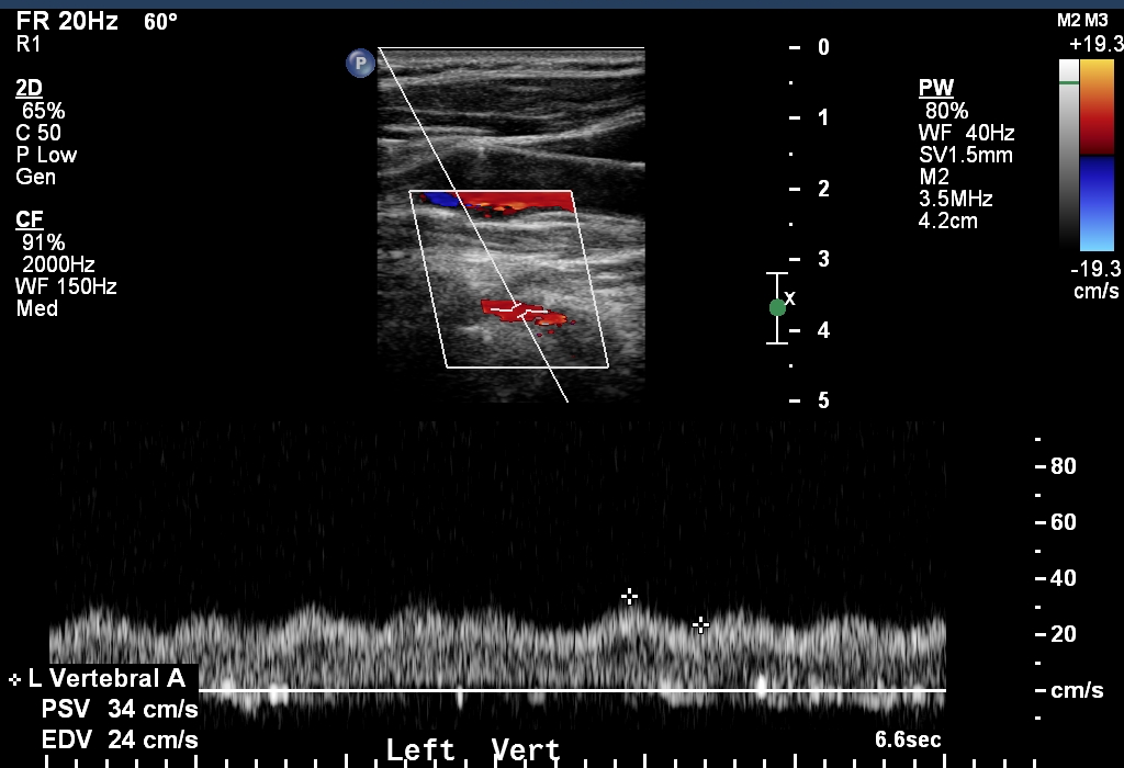 Arterial Doppler in left ventricular assist device patients | Image ...