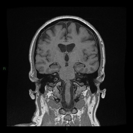 Cerebellar abscess | Image | Radiopaedia.org