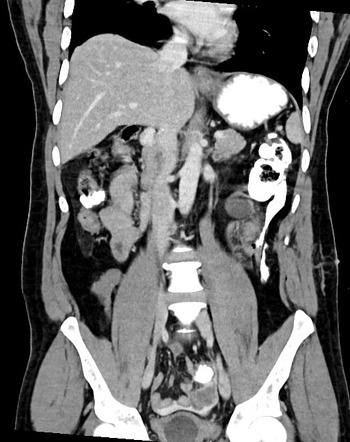 Penetrating trauma (stabbing) injury to the large bowel | Image ...