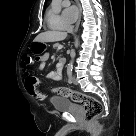 Retroperitoneal/perirenal leiomyosarcoma | Image | Radiopaedia.org