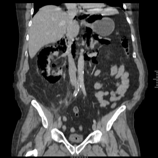 Emphysematous Pyelonephritis Image