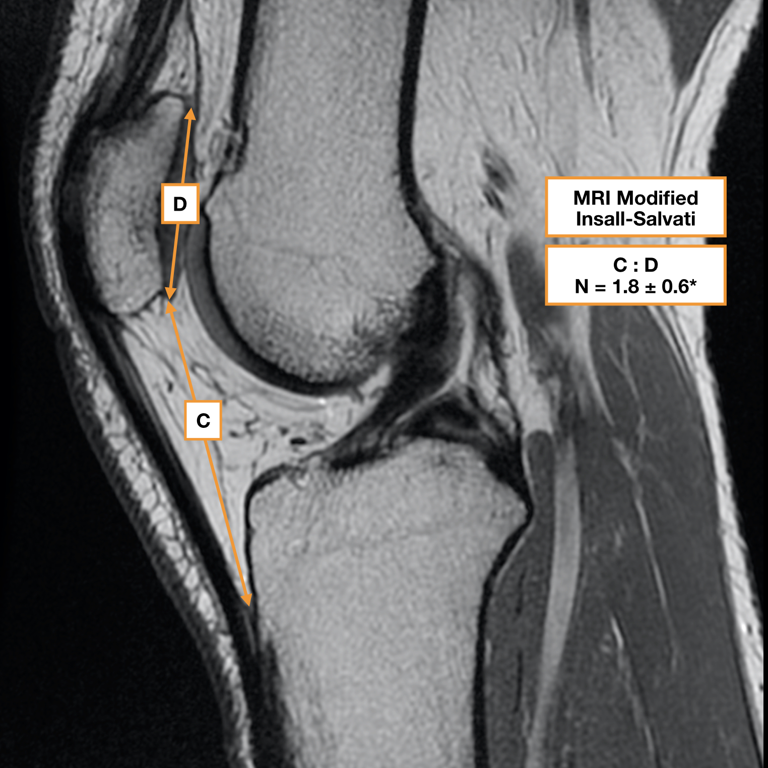 MRI Patellofemoral Instability Measurements (reporting Aid) | Image ...