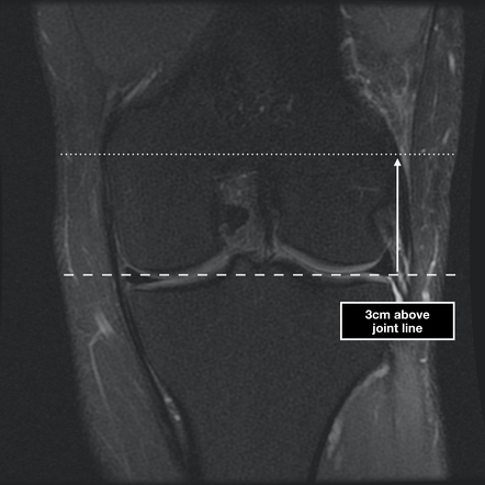 Mri Patellofemoral Instability Measurements (reporting Aid) 