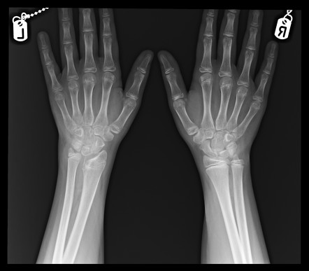 Physeal arrest Radiology Reference Article Radiopaedia