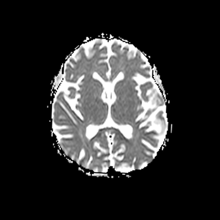 Mitochondrial encephalomyopathy, lactic acidosis, and stroke-like ...