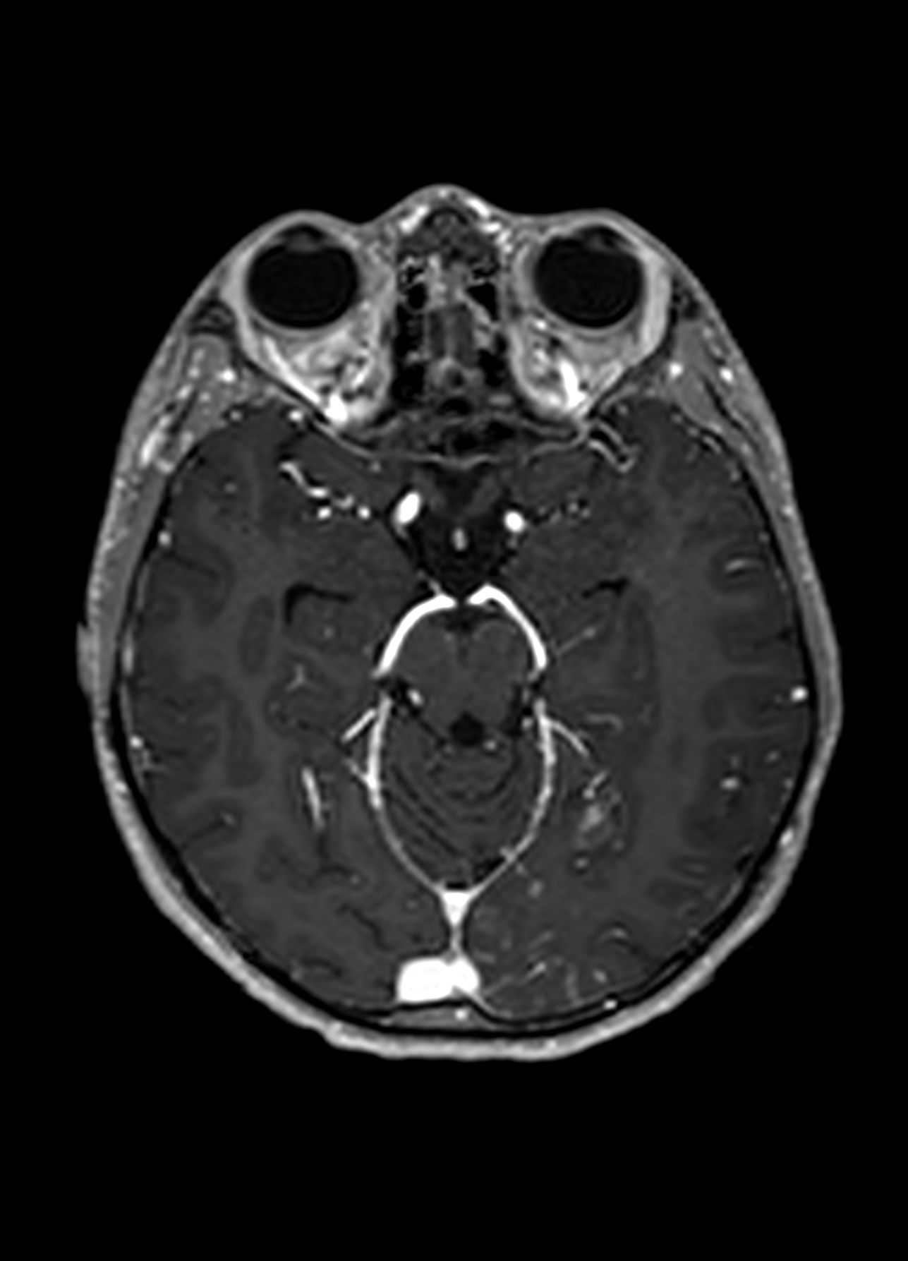 File:Mitochondrial encephalomyopathy, lactic acidosis, and stroke-like ...