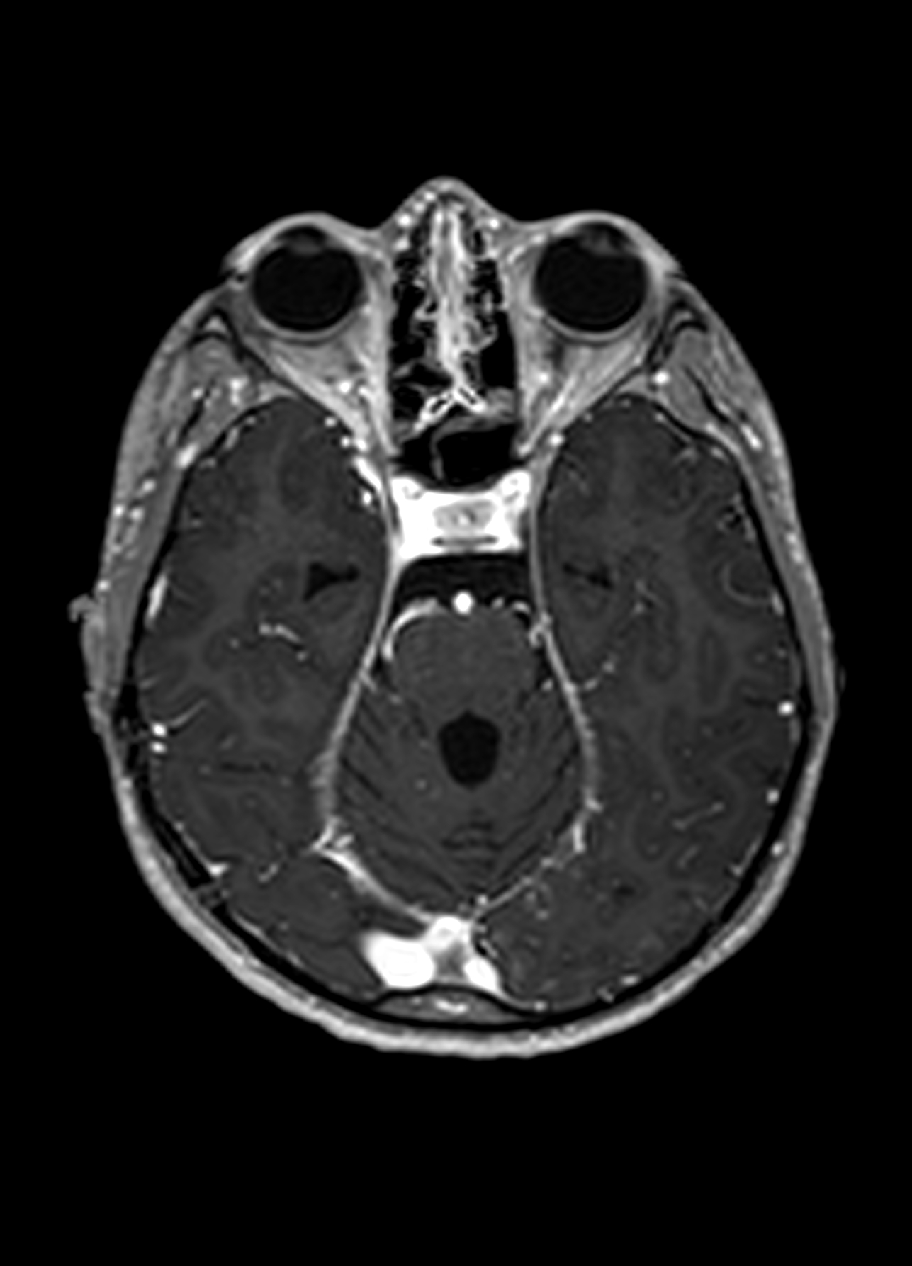 File:Mitochondrial encephalomyopathy, lactic acidosis, and stroke-like ...