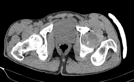 Posterior dislocation of the hip | Image | Radiopaedia.org