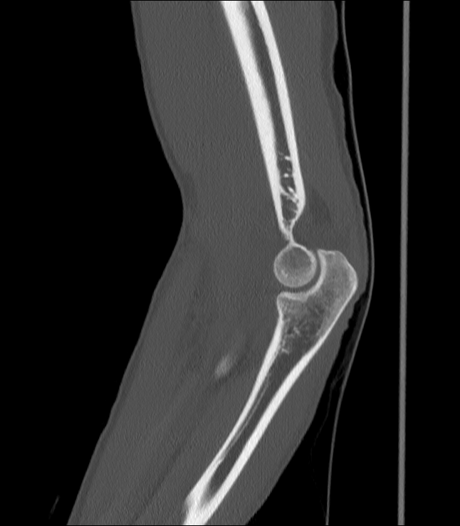 Lateral Epicondyle Debridement