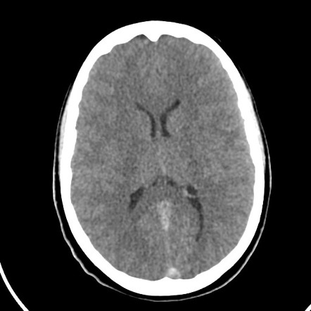 Dural venous sinus thrombosis | Radiology Case | Radiopaedia.org