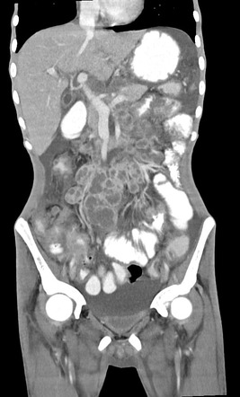 Disseminated tuberculous infection with miliary disease, lymphadenitis ...