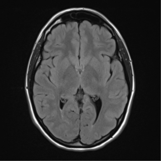 Meningioma - planum sphenoidale with optic atrophy | Image ...