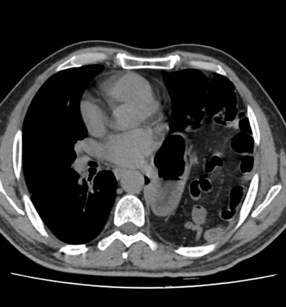 Diaphragmatic Hernia 