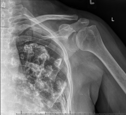 Holy Leaf pleural plaques | Radiology Case | Radiopaedia.org