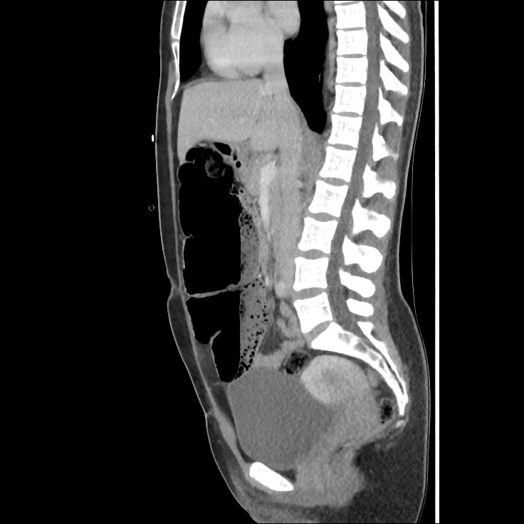 Cecal volvulus | Image | Radiopaedia.org