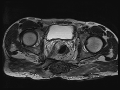 Sacral mycetoma with multiple discharging sinuses | Image | Radiopaedia.org