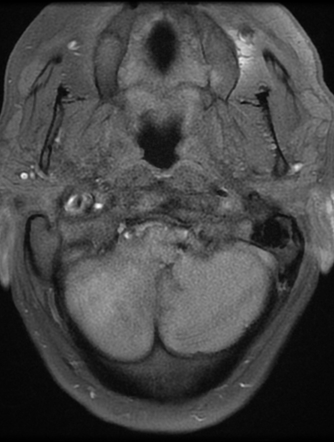 Posterior Circulation Infarction 