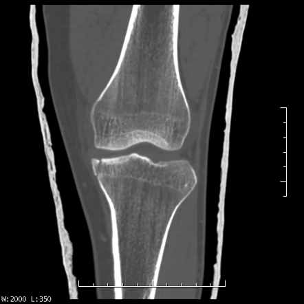 Reverse Segond fracture | Radiology Reference Article | Radiopaedia.org