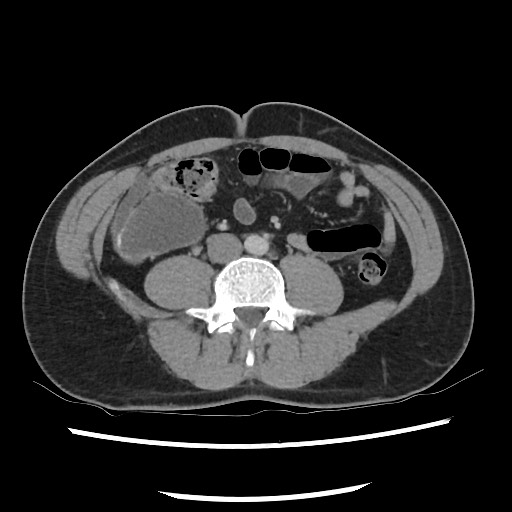 Low Grade Appendiceal Mucinous Neoplasm Image