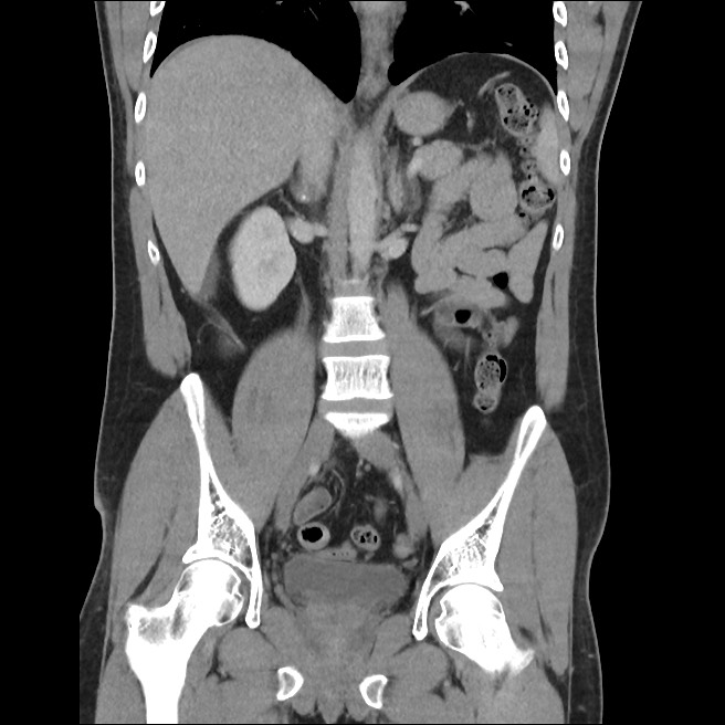 Low-grade appendiceal mucinous neoplasm | Image | Radiopaedia.org