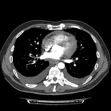 Cardiac tamponade | Image | Radiopaedia.org