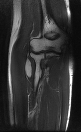 Soft tissues lipoma - elbow | Image | Radiopaedia.org