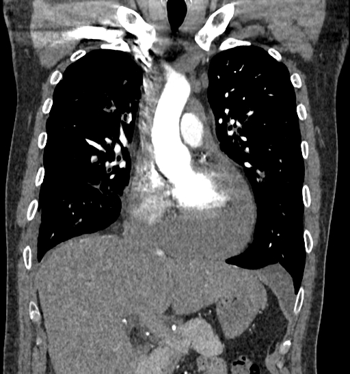 Cardiac tamponade | Image | Radiopaedia.org