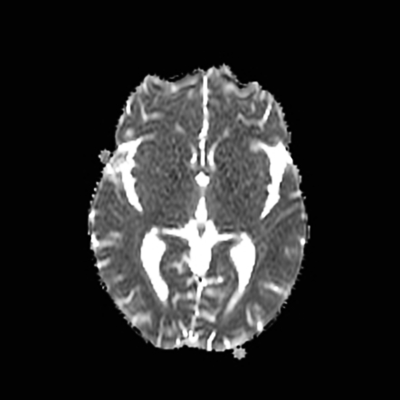 Wernicke encephalopathy | Image | Radiopaedia.org