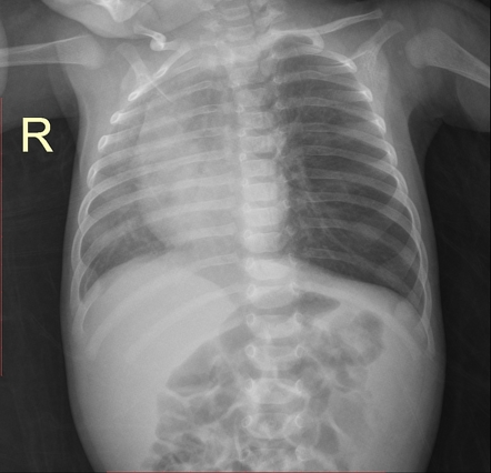 Bronchogenic cyst | Radiology Case | Radiopaedia.org