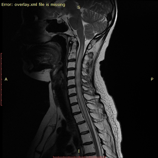 Radiation myelitis | Image | Radiopaedia.org