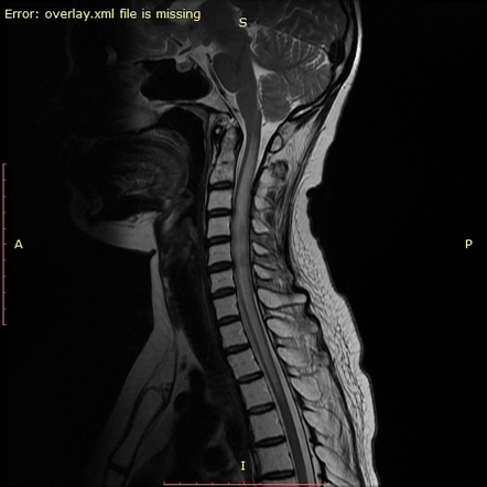 Radiation Myelitis 