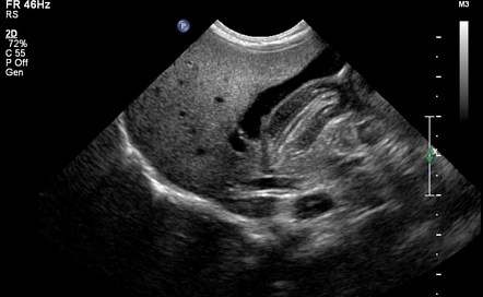 Hypertrophic pyloric stenosis | Image | Radiopaedia.org