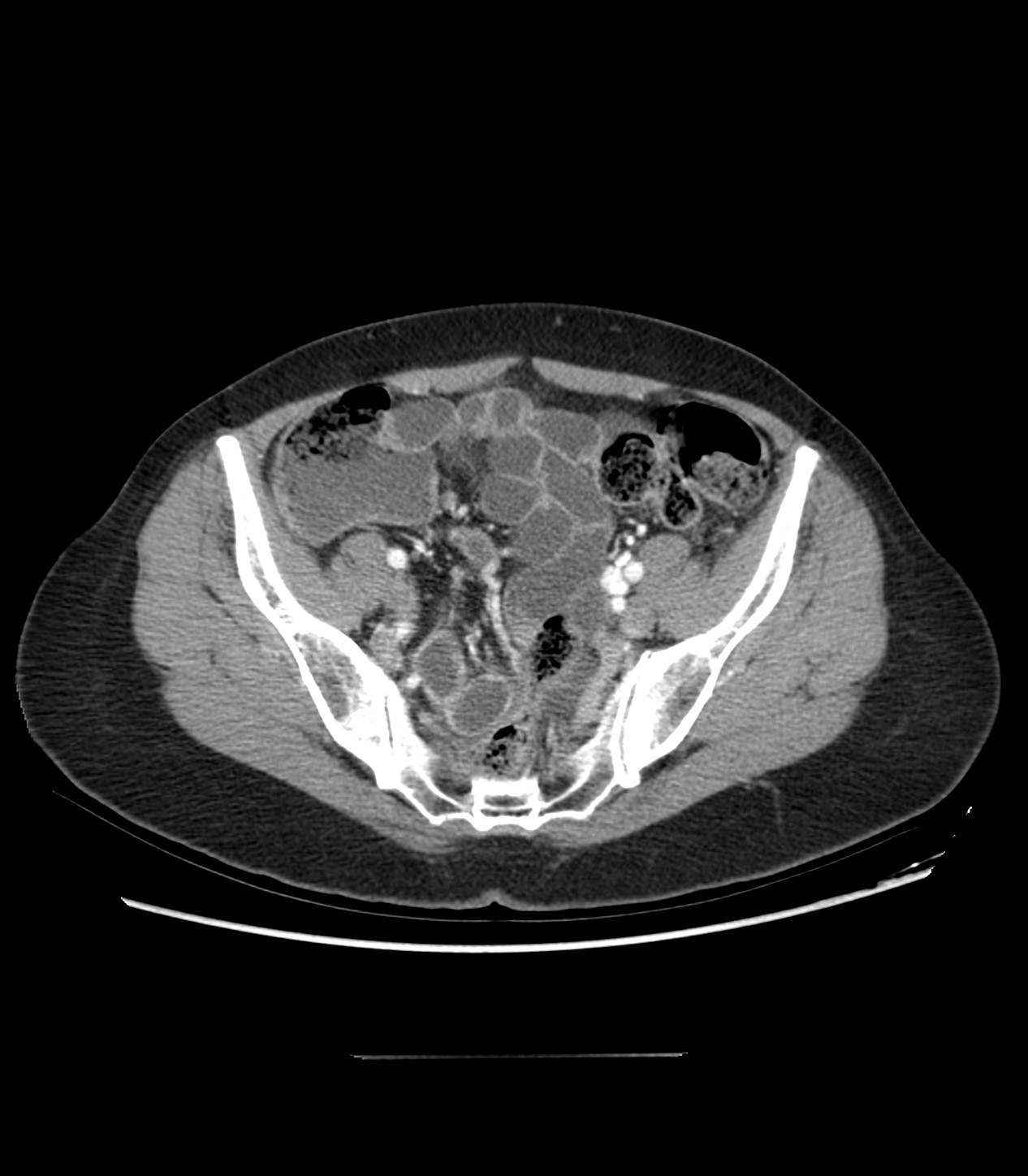 Small Bowel Neuroendocrine Tumor Image