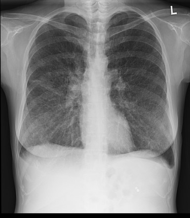 Renal Epithelioid Angiomyolipoma 