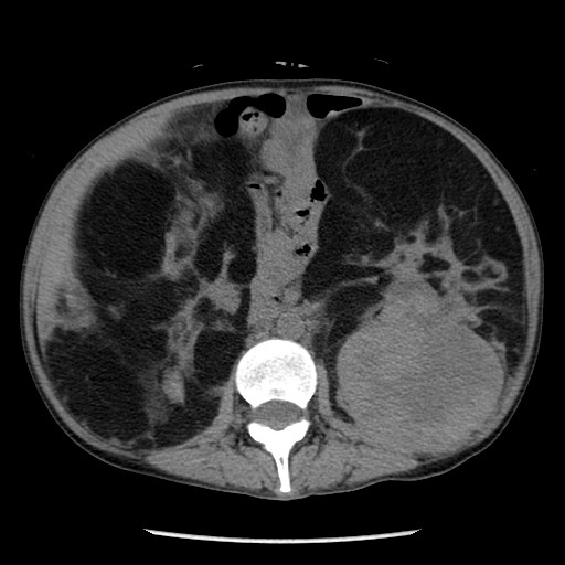 Renal Epithelioid Angiomyolipoma Image