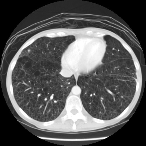 Renal Epithelioid Angiomyolipoma Image