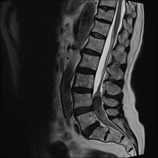 Spinal Hematoma 