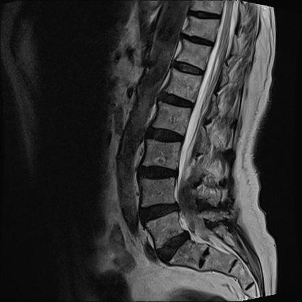 Spinal Intradural Hematoma Radiology Case Radiopaedia Org