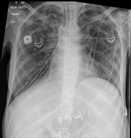 Nasogastric tube positioning | Radiology Reference Article ...