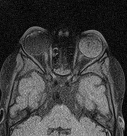 Retinoblastoma | Image | Radiopaedia.org