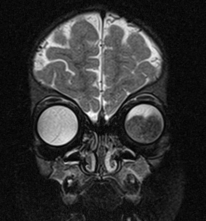 Retinoblastoma | Radiology Reference Article | Radiopaedia.org