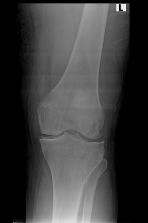 Tibial plateau fracture - Schatzker type I | Radiology Case ...