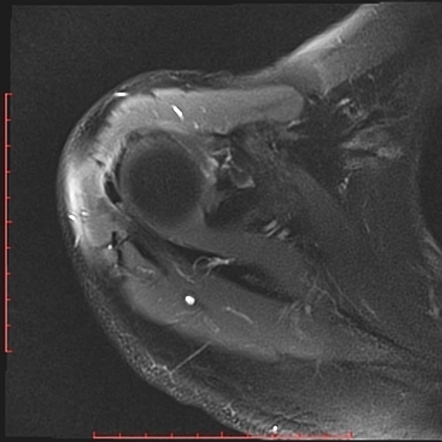 Infraspinatus calcific tendinitis | Image | Radiopaedia.org