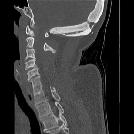 Klippel-Feil Syndrome | Radiology Reference Article | Radiopaedia.org