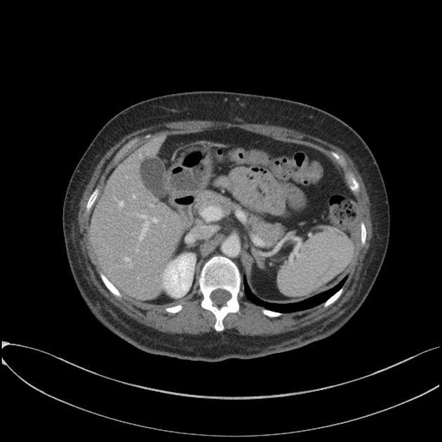 Splenic trauma | Radiology Reference Article | Radiopaedia.org