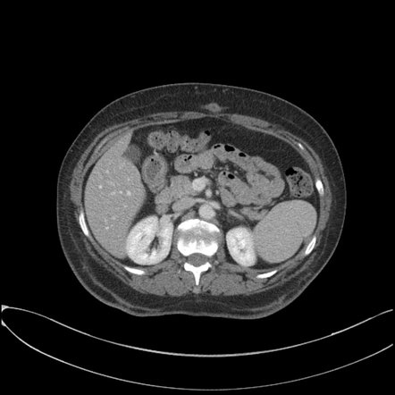 Splenic cleft from diaphragmatic slip | Radiology Case | Radiopaedia.org