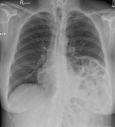 Neurofibromatosis skin lesions on CXR | Image | Radiopaedia.org