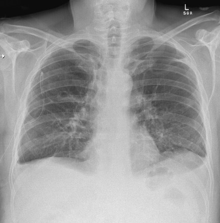 Pulmonary Emphysema X Ray