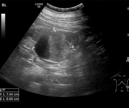 Renal oncocytoma | Image | Radiopaedia.org