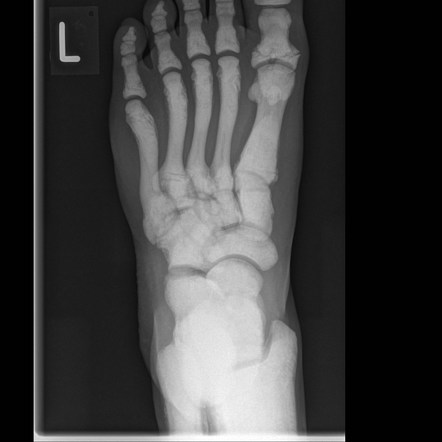 Osteopetrosis | Radiology Reference Article | Radiopaedia.org